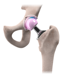 Image of a replacement hip