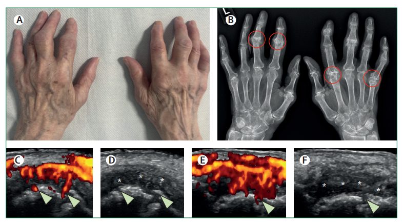 An image showing a photograph, x-ray image and 4 other medical scans of hands with rheumatoid arthritis.