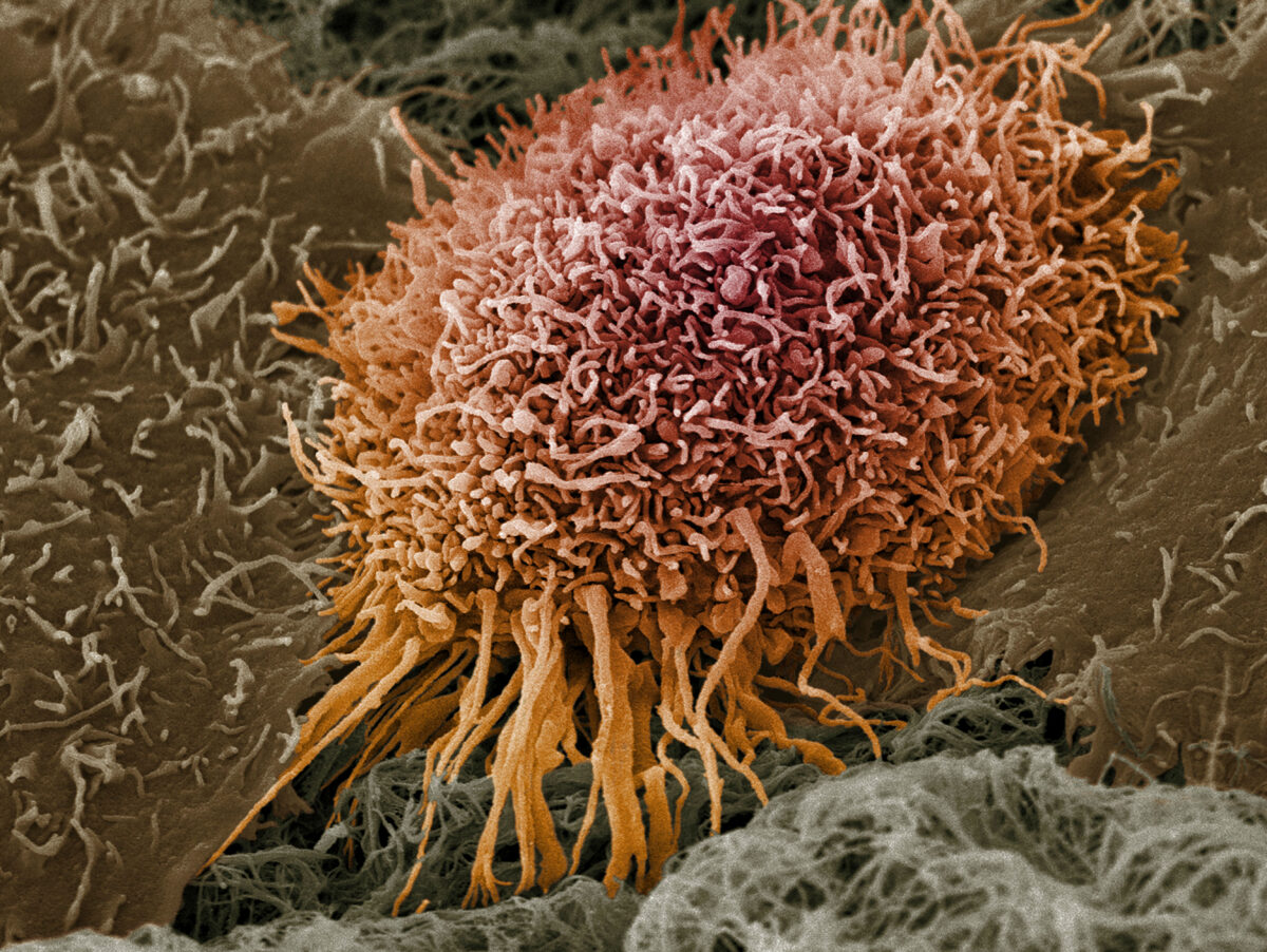 Oral cancer cell
